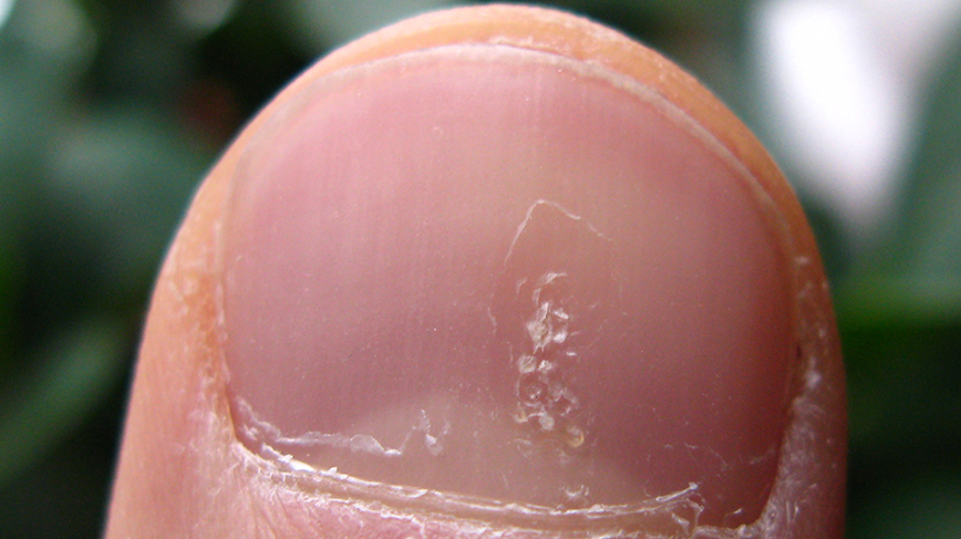 Nail displaying the characteristic pitting of psoriasis. Photo: Seenms/CC BY-SA 3.0