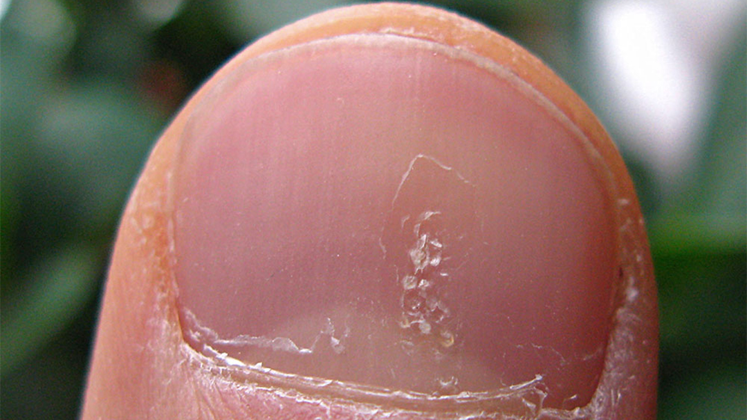 Nail displaying the characteristic pitting of psoriasis.