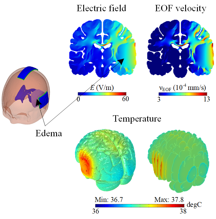 Electroosmosis based novel treatment approach for cerebral edema