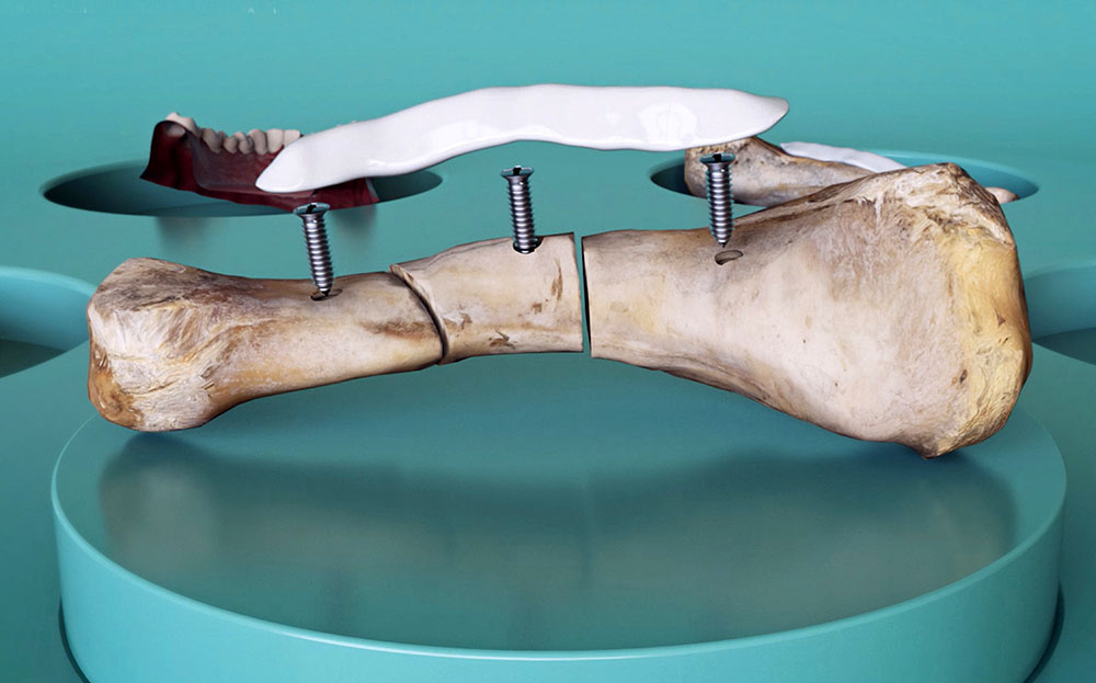 A bone with screws to hold it together, plus the polymer custom-made patch.