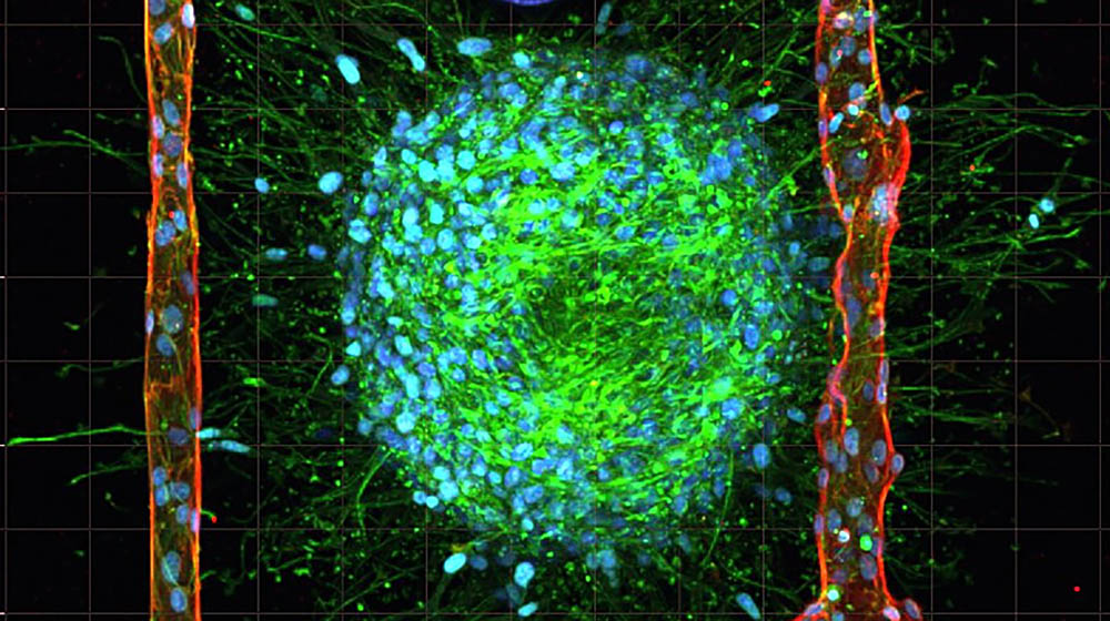 Bild på hydrogel med cancerceller och artificiellt skapade blodkärl