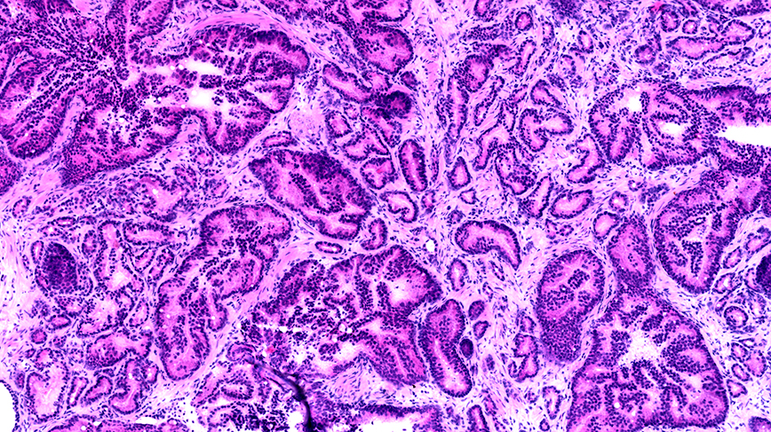 tumor cells within a section of prostate tissue seen in a microscope