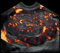 Ovarian cancer tumor