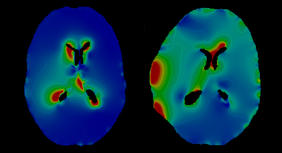 Höger bild visar tydligt hur töjningen av nervtrådarna i hjärnan kan se ut efter en dekompressiv kraniotomi.