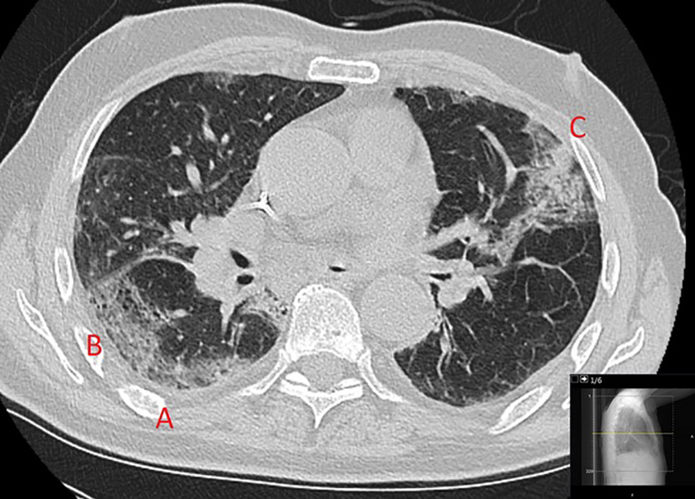 En röntgenbild som föreställer ett par lungor. Bilden visar kroppen i genomskärning, förmodligen skiktröntgen. Vyn är endera ovan- eller underifrån. Tre ljusare fält i lungorna, som är mörkare, är markerade med bostäverna A, B och C. Dessa indikerar förtätning av lungvävnaden. En liten, infälld bild i den större bilden, visar en röntgenbild av lungor från höger sida.